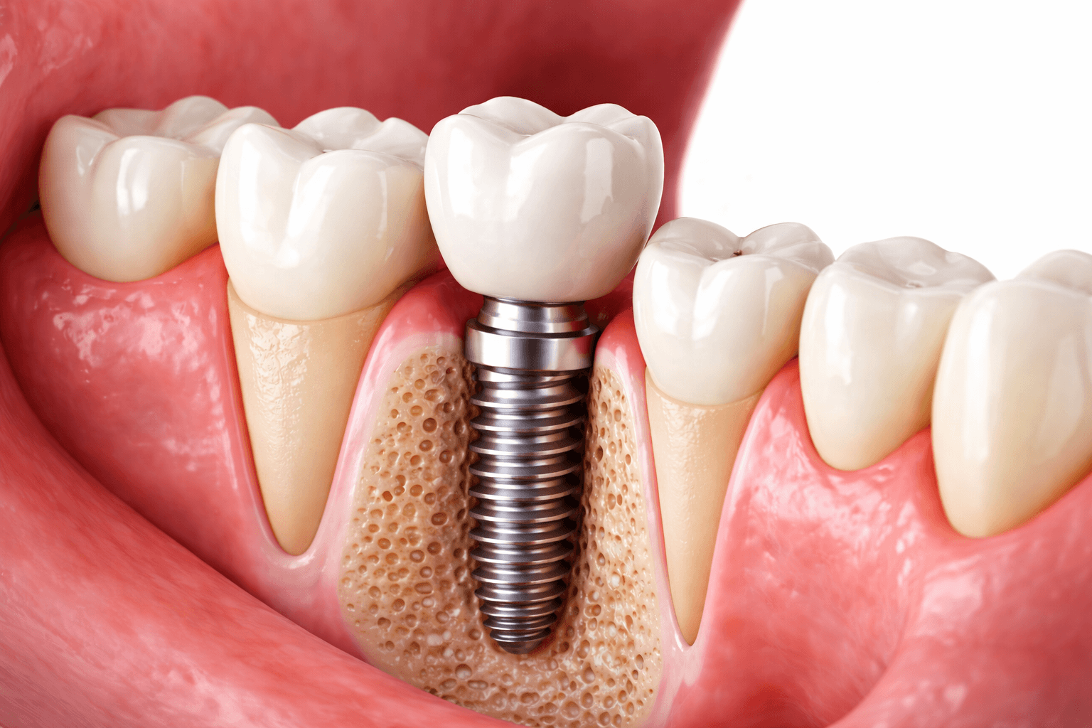 implantee-dentario-em-recife